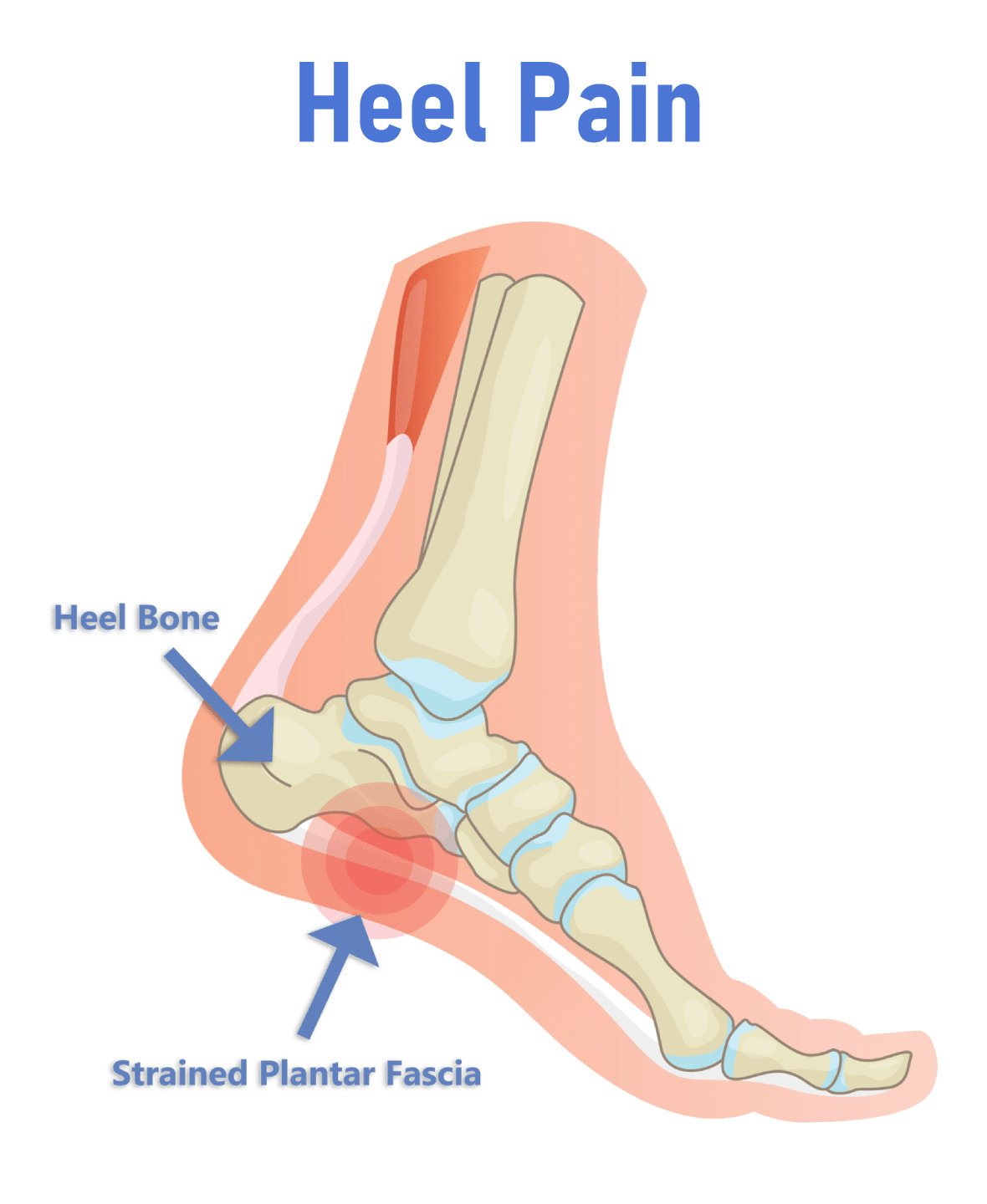 Heel Pain (Plantar Fasciitis) | Sports & Spinal Physiotherapy HK